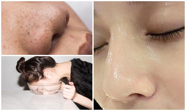 Nguyên nhân và các cách điều trị mụn đầu đen hiệu quả tại nhà